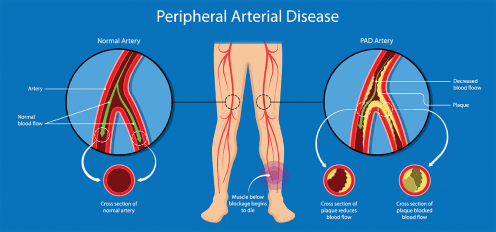 Peripheral Arterial Disease