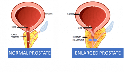 prostate