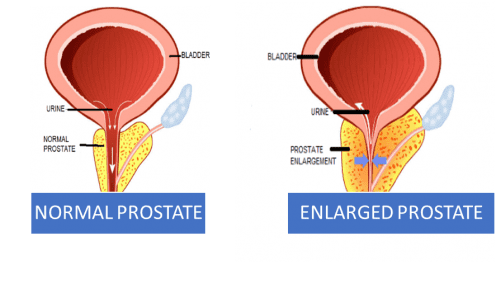 Cancer Screening For Prostate